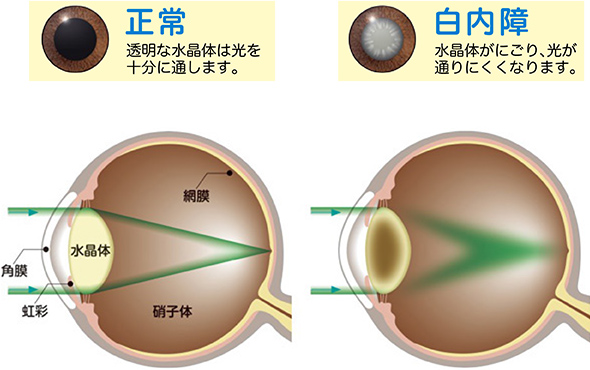 白内障とは