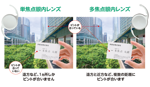眼内レンズには「単焦点」と「多焦点」があります。