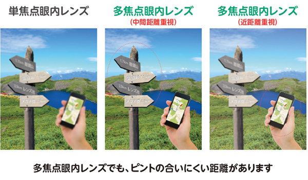 多焦点眼内レンズにも、種類があります