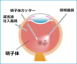 網膜硝子体手術の方法