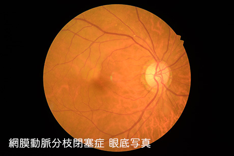網膜中心静脈閉塞症とは?
