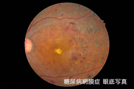 糖尿病網膜症とは?