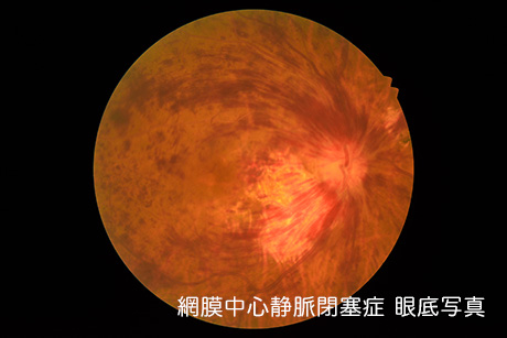 網膜静脈閉塞症とは?