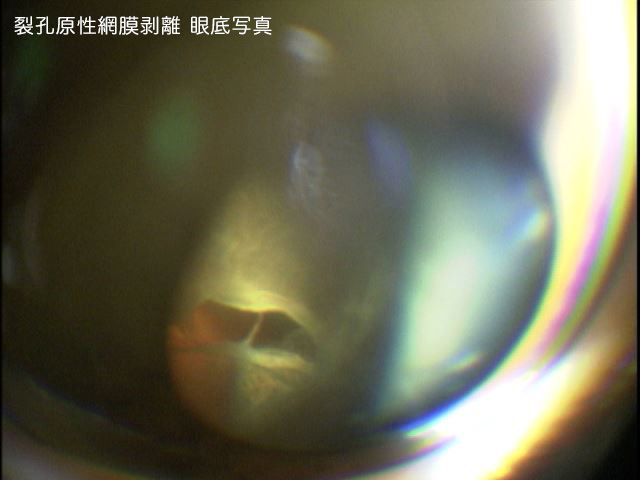 網膜裂孔・裂孔原性網膜剥離とは?